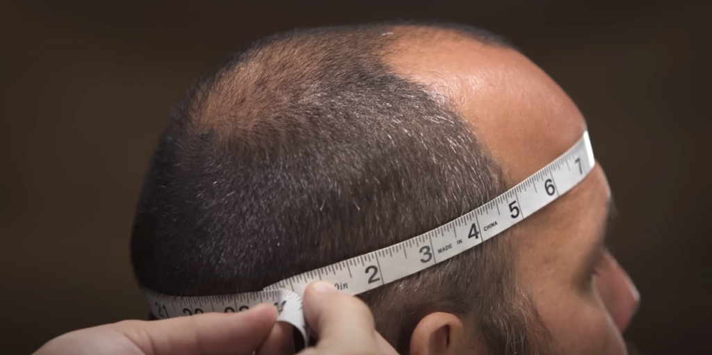 Tape measure around man's head